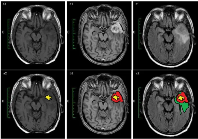 Figure 4: L’imagerie IRM d’un glioblastome temporal gauche.  