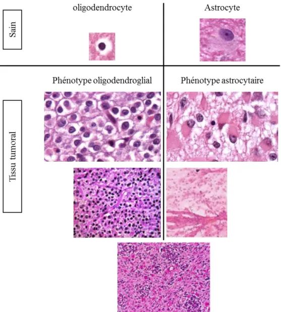 Figure 5 : Les phénotypes oligodendroglial et astrocytaire des gliomes observés en marquage  H&amp;E