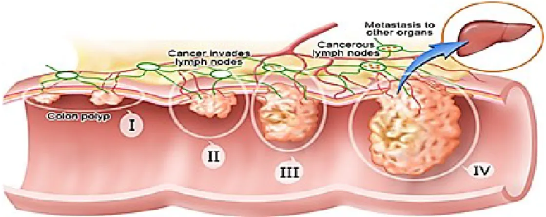 Figure 5 : illustration des 4 grades de l’évolution tumorale, du stade 0 au stade IV avec l’invasion des cellules cancéreuses  vers d’autres organes via la circulation sanguine (source : 