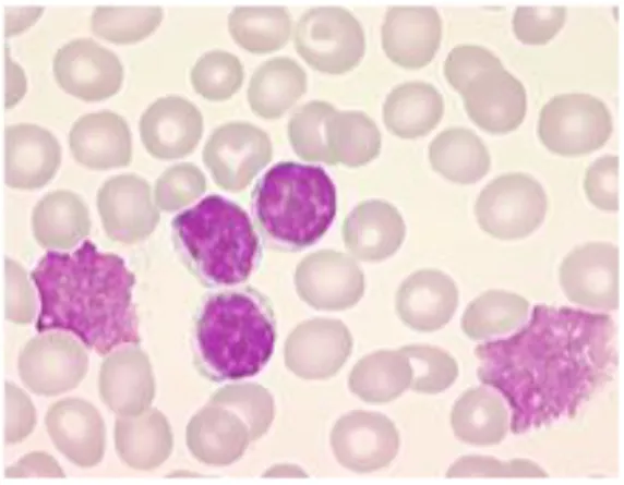 Figure 1 :  Analyse cytologique des cellules sanguines d’un patient atteint de LLC. Les lymphocytes B de LLC  sont identifiés par un marquage violet du noyau et la présence d’un cytoplasme très réduit