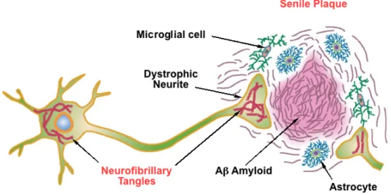 Figure 1 : Lésions neuropathologiques présentes dans la maladie d’Alzheimer : plaques amyloïdes  et dégénérescences neurofibrillaires