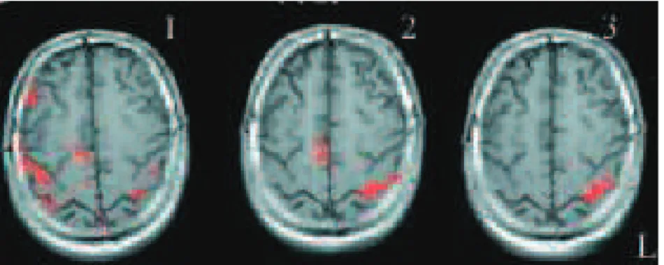 Figure 16 : Pattern d’évolution de l’activation cérébrale d’un patients post-AVC, avec  M1 épargné, pendant le mouvement de la main affectée (droite)