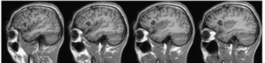 Figure 8. Images sagittales (a) et coronales (b) pondérées en T1 du patient DB montrant une  lésion localisée dans le cortex insulaire antérieur droit et la partie adjacente du cortex frontal  inférieur droit (opercule)