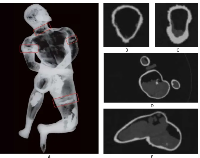 Figure 1.12 : A, les zones d’assemblage par soudage sont signalées en rouge sur la radiographie X du Gaulois  captif  d’Arles,  (h :  63  cm),  1 er   s