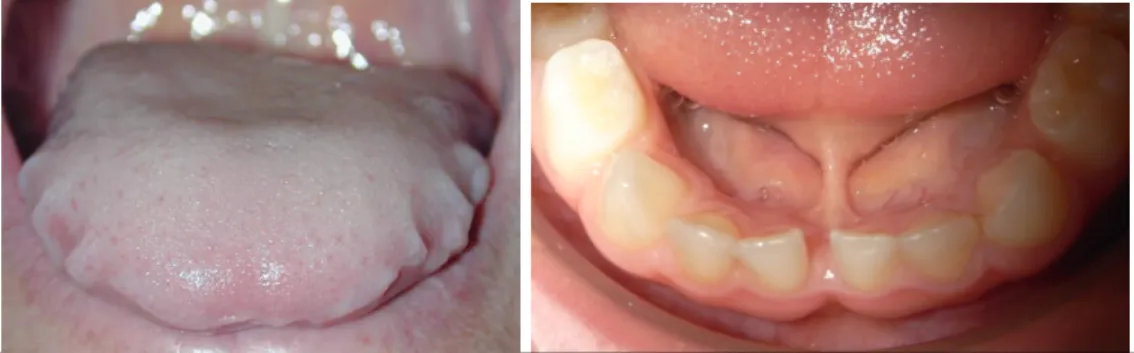 Figure 9: a) macroglossie relative (noter la langue aux bords crénelés) Dr B. Pételle, Paris, b)  brieveté du frein, maintenant la langue en position basse et entretenant un diastème   