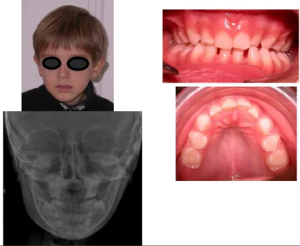Figure 18: Cas de SAOS résiduel  chez un enfant de 4 ans(IAH de 6 par heure) malgré l’ablation  des  végétations  des  amygdales
