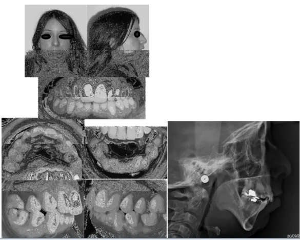 Figure 22: syndrome  de  Stiff  Skin : vues  exobuccales,  endobuccale,  téléradiographie  de profil