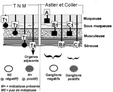 Figure 4  : Stades TNM et d’Astler-Coller du cancer colorectal  [Source : 