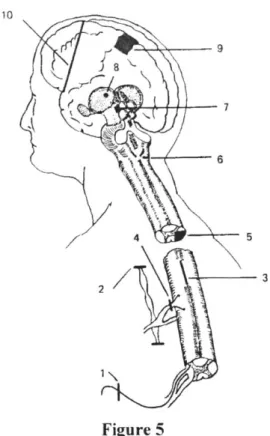 Diagram  of various  surgical  procedures  designed  to  alleviate  pain:  1, nerve  section;  2, sympathectomy  (for  visceral  pain);  3,  myelotomy  to  section  spinothalamic  fibers  in anterior  white  commissure;  4,  posterior  rhizotomy;  5,  ante