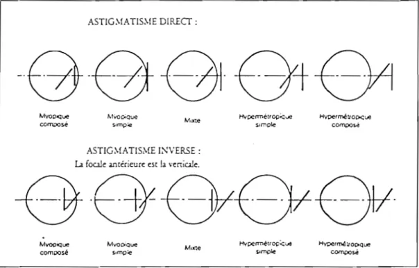 Fig.  1 :  Variétés  d'astigmatismes  réguliers  (d'après BINAGHI et  coll.) 