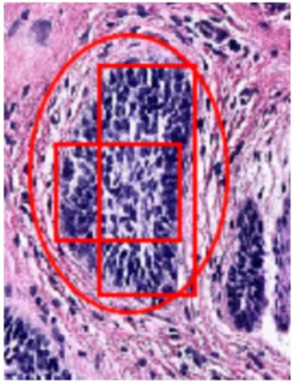 Figure 2-2: A section of skin with BCC annotated with an oval by the dermapathol- dermapathol-ogist and with minimal annotations on top