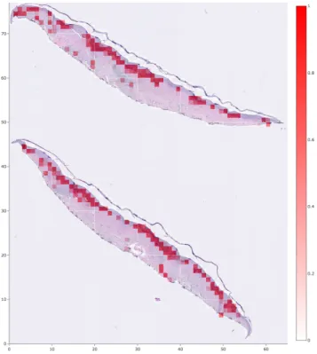 Figure 2-3: A positive WSI with a heatmap overlaid to visualize which patches obtained higher scores
