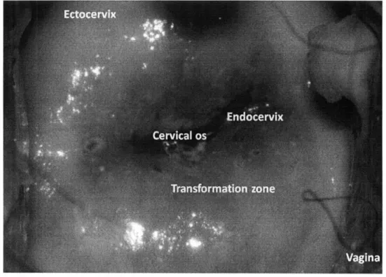 Figure  2.2:  White-light  photograph  of  the  cervix  acquired  by  a  digital  colposcope (CooperSurgical,  Inc.) after  the application of 5%  acetic acid