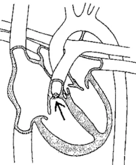 Figure 6  :  La sténose de la voie pulmonaire 