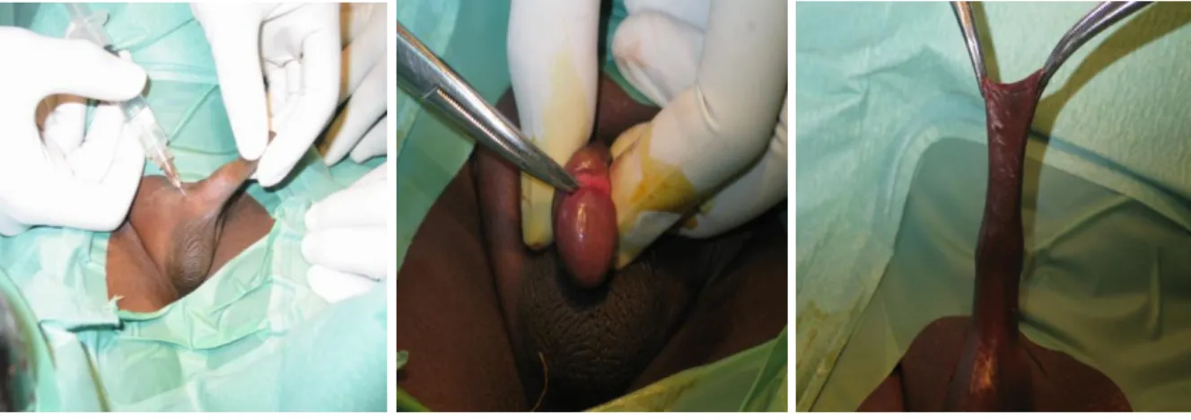 Figure  10 :  Circoncision  utilisant  la  pince  de  Kocher  (Diapothèque  Urologie  HALD) 