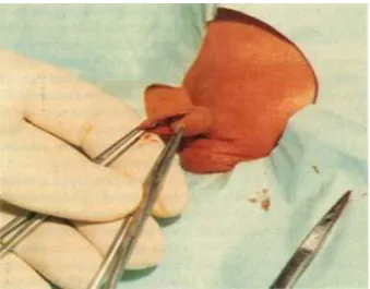 Figure 12 : circoncision avec le clamp de GOMCO  31A. mise en place de pinces sur 