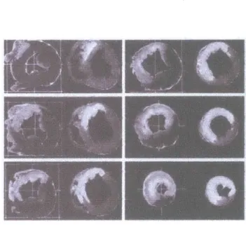 Figure 5.2-  Blood  volume  pictures with  Gd-DTPA showing  infarcted area as hyperenhanced