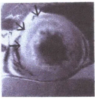 Figure 5.4 - Example  of  T2 weighted  image  for  detection  of ischemic  region.  Hyperintense  area denotes ischemic  region.