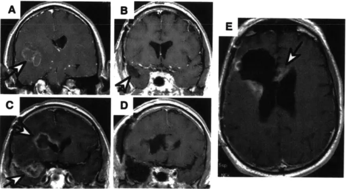 Figure  1.1  MRI  images  of a GBM  patient. A coronal  MRI  image  depicting a  GBM  lesion (indicated by the  white arrow)  (A)