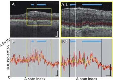 Fig. 6. B-scan analysis of the HOC projection for Case 3, showing ONL/HFL thinning.