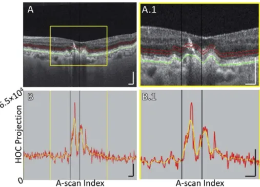 Fig. 8. B-scan analysis of the HOC projection for Case 4, which shows an HRF having an RPE plume appearance