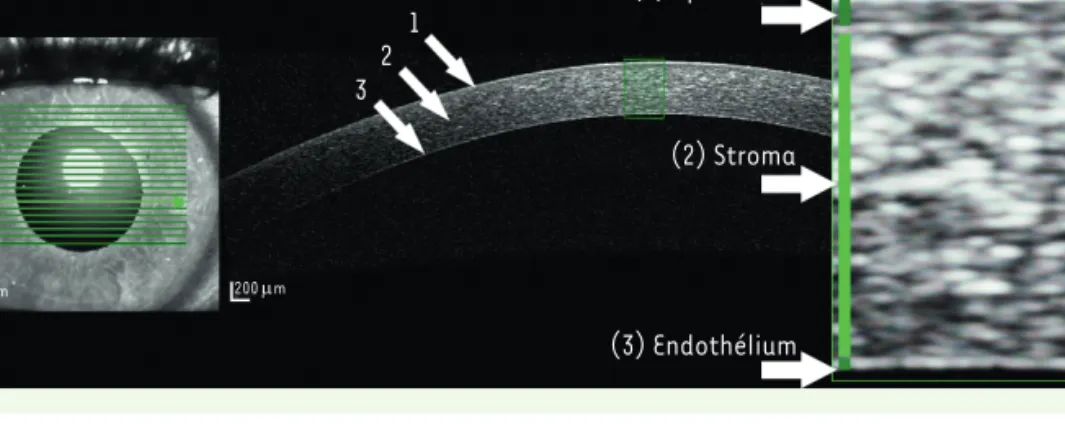 Figure 2.  Coupe d’une cornée  réalisée avec un dispositif  d’imagerie AS-OCT. On distingue  l’épithélium en surface (1), le  stroma (2) et la couche  endo-théliale (3) de la cornée.