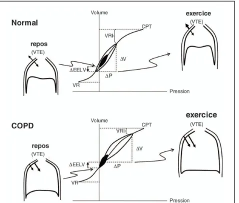 Figure 6 : Relations pression-volume (P-V) du système respiratoire à l’état normal et en cas  de  BPCO,  avec  la  représentation  de  la  zone  du  volume  courant  (en  noir)  et  de  son  augmentation  à  l’exercice  (en  blanc)