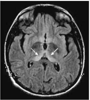 Figure 15 : Aspects IRM au cours de la vMCJ.  