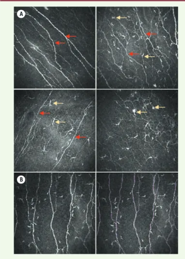 Figure 4. Images obtenues en microscopie confocale in vivo montrant la présence plus  ou moins importante de cellules hyperréflectives (cellules dendritiques  inflamma-toires, flèches jaunes) dans le plexus nerveux sous-épithéliaux humain