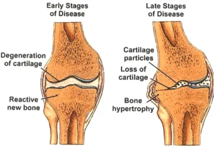 Figure  1.1  Progression  of Osteoarthritis in  the Knee.  The  early and  late  stages  of  osteoarthritis are  depicted  in  a  knee  joint  where  we  can  see  how  articular  cartilage  is  degenerated  over  time, affecting  the  adjoining bones  in 