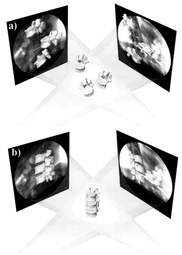 Figure 2-7  a)  The  3D  model  of the lumbar  spine  segments  (from  human  MRI) were  introduced  into virtual  system  reproduced  from  geometry  of  DFIS
