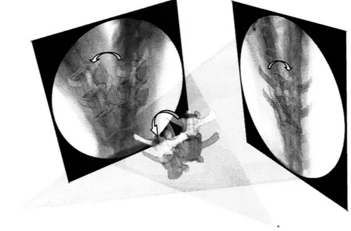 Figure  3-3:  The  specimen  was  manually  flexed  to  simulate  a  physiologic  motion  when  two fluoroscopes  captured  images  simultaneously