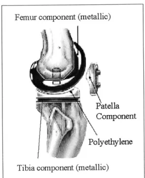 Figure  1.1:  Lateral  view  of right knee  after  TKA.