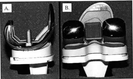 Figure  2.6: Posterior  cruciate retaining TKA  (right knee).