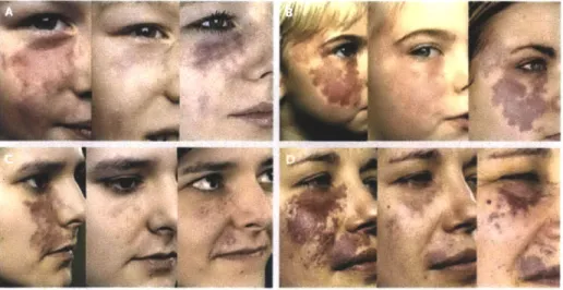 Figure  1-2:  Redarkening  of  PWS  after  PDL  treatment.  Each  panel  shows  a  pa- pa-tient  before  treatment  (left),  after  six  treatments  of PDL  (middle),  and  at  follow  up examination  after  9  years  (Panel  A)  of  10  years  (Panel  B,C