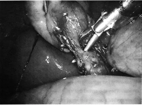 Figure 2-5.  The use  of grippers for blunt dissection  in cholecystectomy  (Laparoscopy.com).