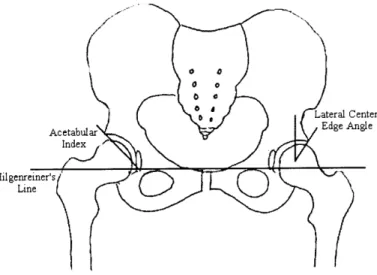 Figure  2.2:  Schematic  diagram  of  the  full  pelvis  describing radiographic  parameters  used in the  diagnosis  of hip  dysplasia.