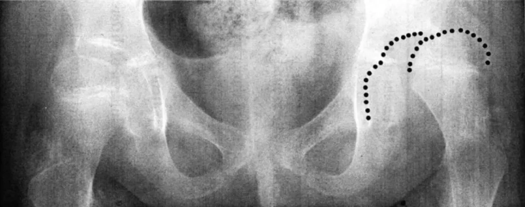 Figure  2.4 Plain  radiograph  of Patient  la in neutral  position, with the  left acetabulum femoral  head  digitized for  curve  fitting.