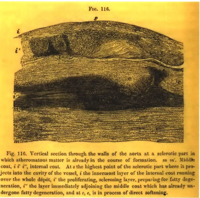 Figure  1.7:  Engraving on wood  of one  of the earliest histological  section  of an atherosclerotic lesion.
