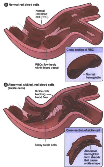 Figure  1-2:  Graphic  depicting  normal  RBC  versus  sickled  RBC  behavior  with  key difference  being  blockage  of inlet  to microcirculation  passage