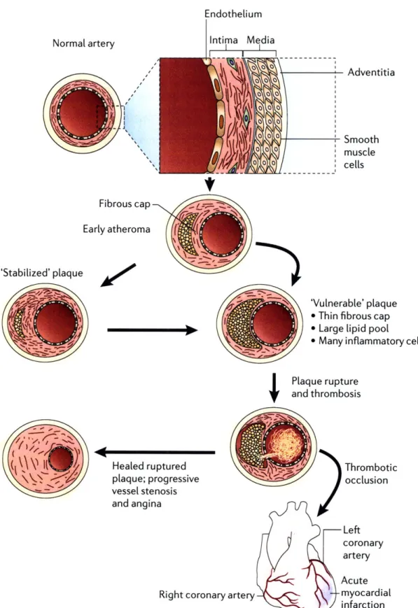 Figure  1-2:  Stages  of atherosclerosis.  Reprinted  by  permission  from  Macmillan  Publishers Ltd:  Nature  Reviews  Genetics  [5],  @  2006.