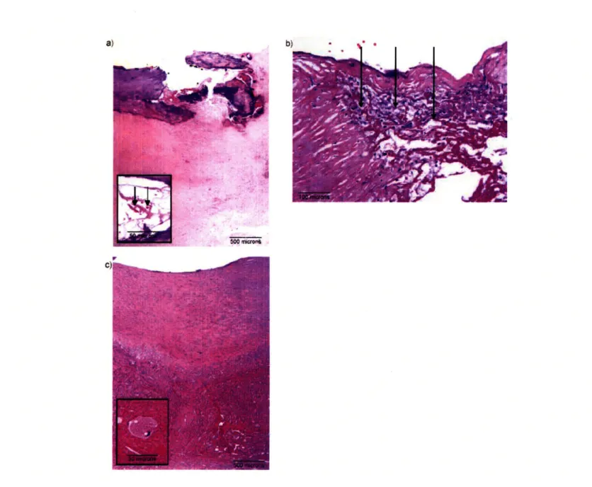 Figure  2-5.  Photomicrographs  of representative tissue  sites:  a) specimen  #14,  an  ulcerated vulnerable  plaque  with acute intraplaque  hemorrhage  (insert;  arrows indicate  red blood cells)  and  hemoglobin fit  contribution of 9.5  (mg/mL) (H&amp