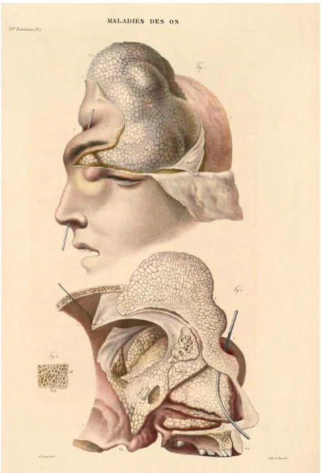 Fig. 31. « Néoplasme osseux sur le crâne », Cruveilhier, J., Anatomie pathologique du corps humain, 1829,  21 ème  Lieraison, Pl