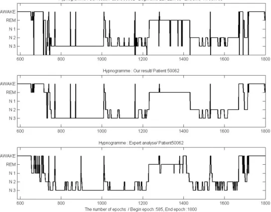 Figure 2.39 – Comparaison de l’hypnogramme de l’expert avec ceux obtenus par l’analyse automatique du patient 50062