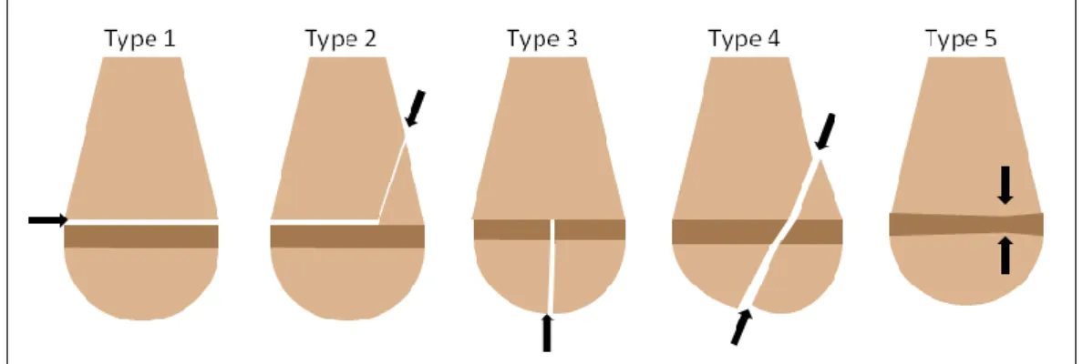 Figure 33 - Schématisation de la classification de Salter et Harris des fractures épiphyso-métaphysaires  (les types 1 et 2 présentent des atteintes moins grave du cartilage que les types 3, 4 et 5 qui auront donc  des conséquences différentes sur la crois