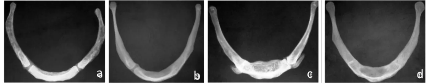 Figure I. 11 : Différents stades de fusion des grandes cornes au corps de l'os hyoïde  (d'après Harjeet et al