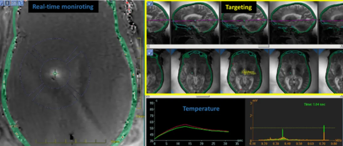 Figure 1.1: Screenshot of a focused ultrasound brain sonication showing anatomical and real-time thermal data.