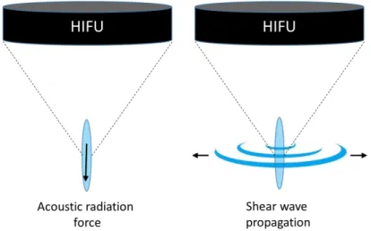 Figure 2.16: Displacement and shear wave generation. During an HIFU pulse, the radiation pressure induces a displacement at the focus A)