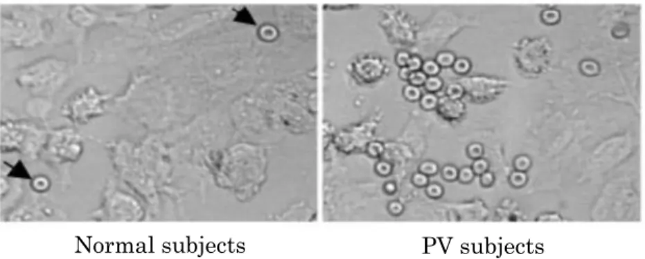 Figure 3. Microscopic image that shows that RBCs adhere more in PV patients than in normal  subjects