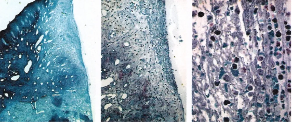 Fig. 7 Muqueuse péri-implantaire après 4 jours de cicatrisation. Un réseau de fibrine présentant une forte infiltration de  leucocytes est observé à l’interface avec le titane